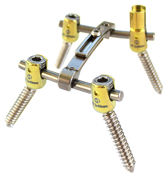 CapLOX II Construct with Cross Connector and pedicle screws
