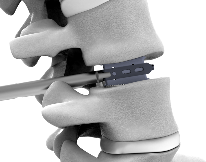 Expandable Lumbar Cage System - EquiLOX - MIS Spine Fusion